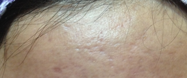 Acne Scarring Dermapen Microneedling Therapy in Exmouth