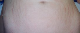 Stretch Marks Dermapen Microneedling Therapy in Exmouth