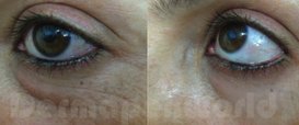 Fine Lines and Wrinkles Collagen Induction Therapy in Exmouth