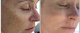 Fine Lines and Wrinkles Dermapen Microneedling Therapy in Exmouth