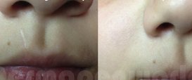 Surgical Scars Collagen Induction Therapy in Exmouth