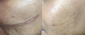 Surgical Scars Dermapen Microneedling Therapy in Exmouth